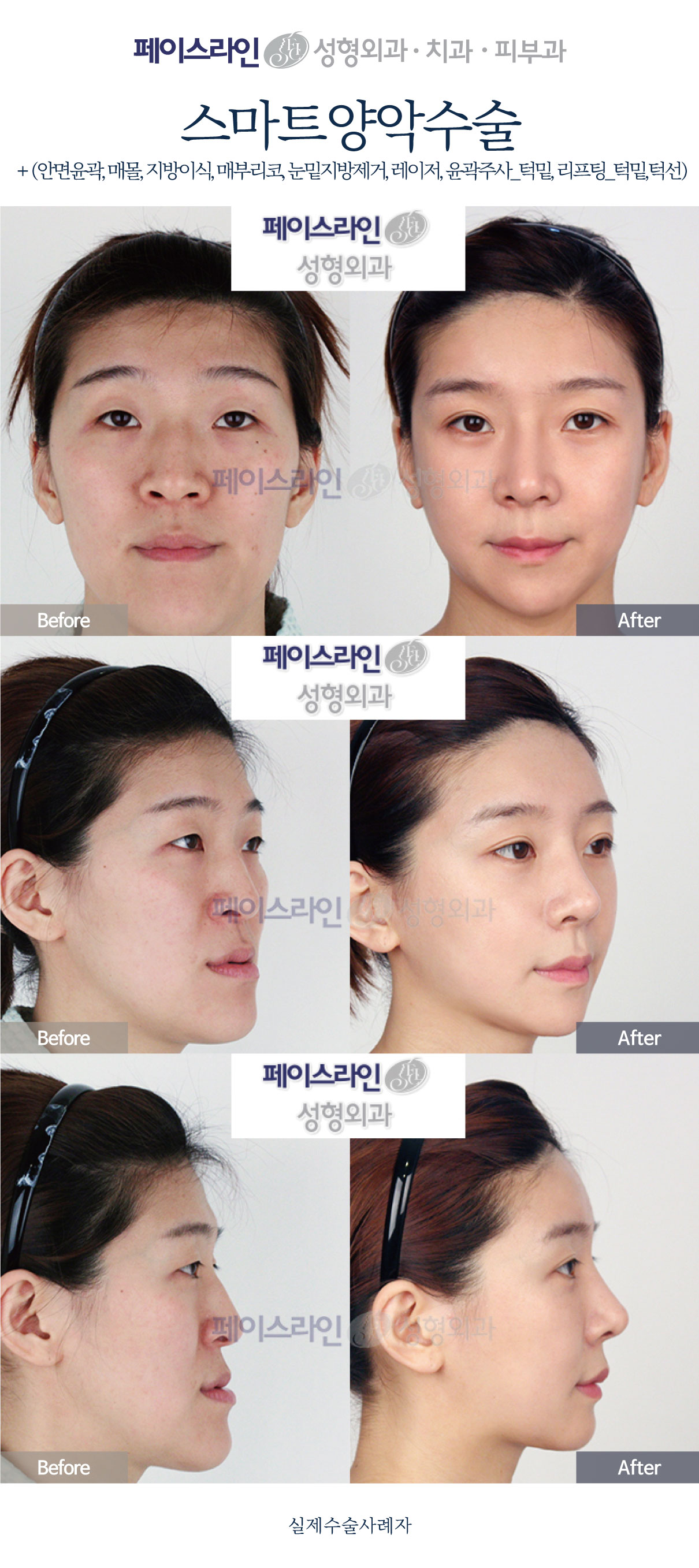Front, angled and profile views; before on the left and after on the right.