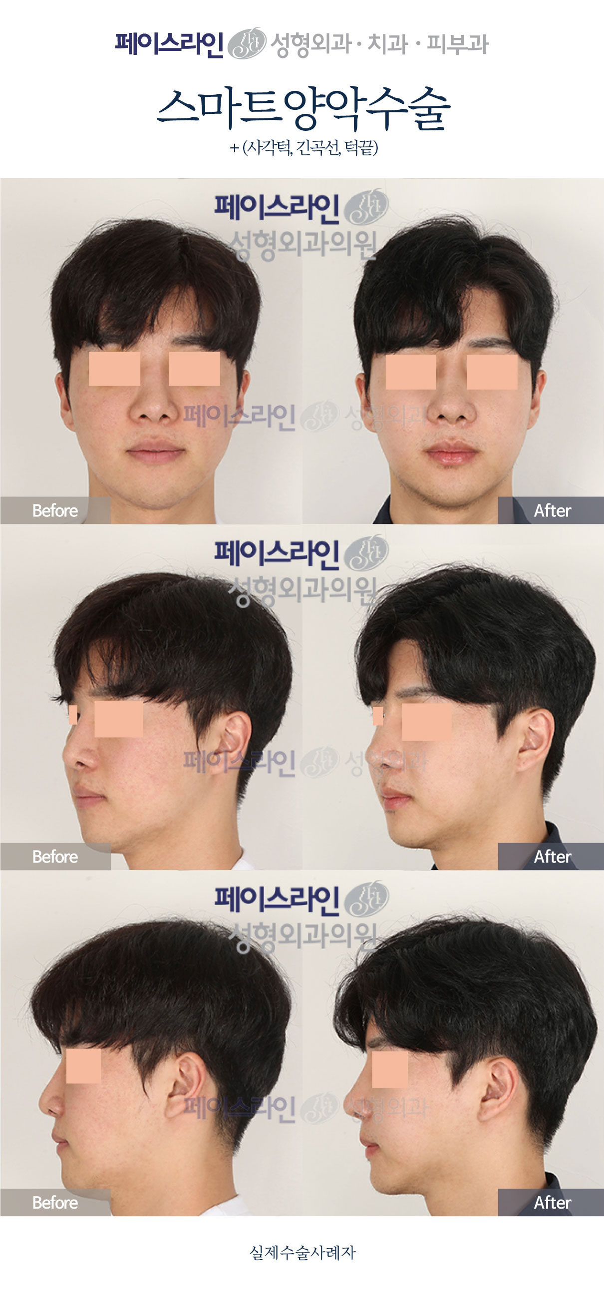 Front, angled and profile views; before on the left and after on the right.