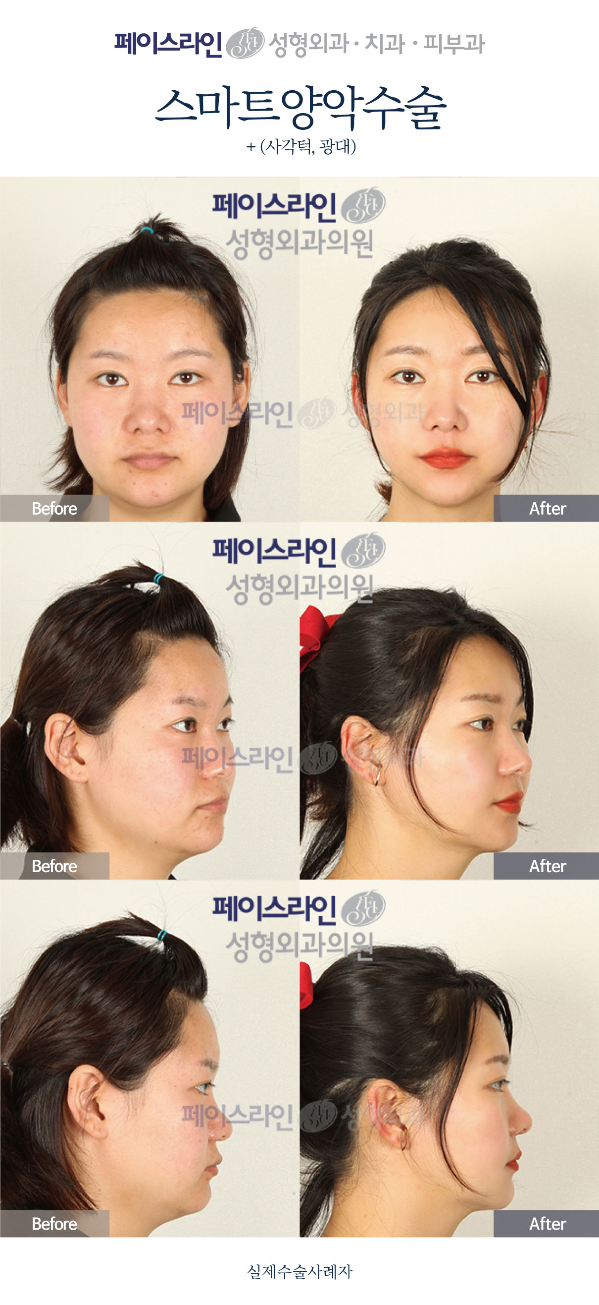 Front, angled and profile views; before on the left and after on the right.