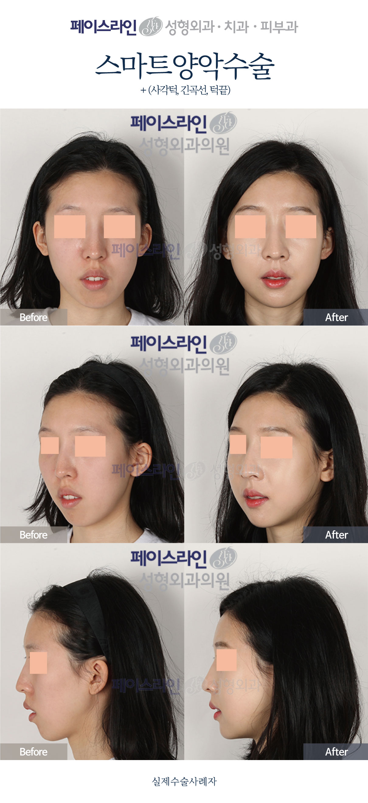 Front, angled and profile views; before on the left and after on the right.
