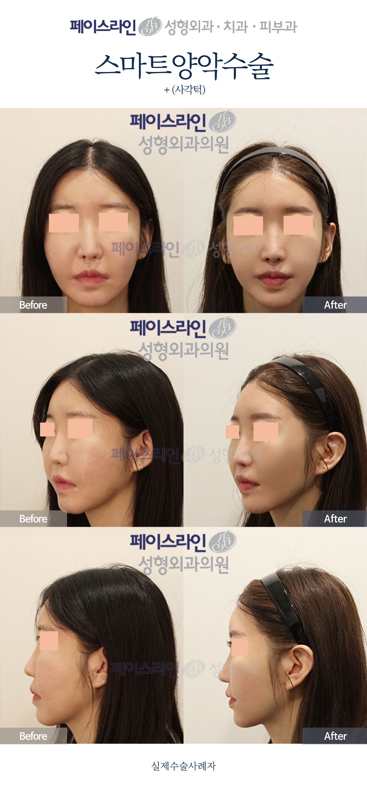 Front, angled and profile views; before on the left and after on the right.