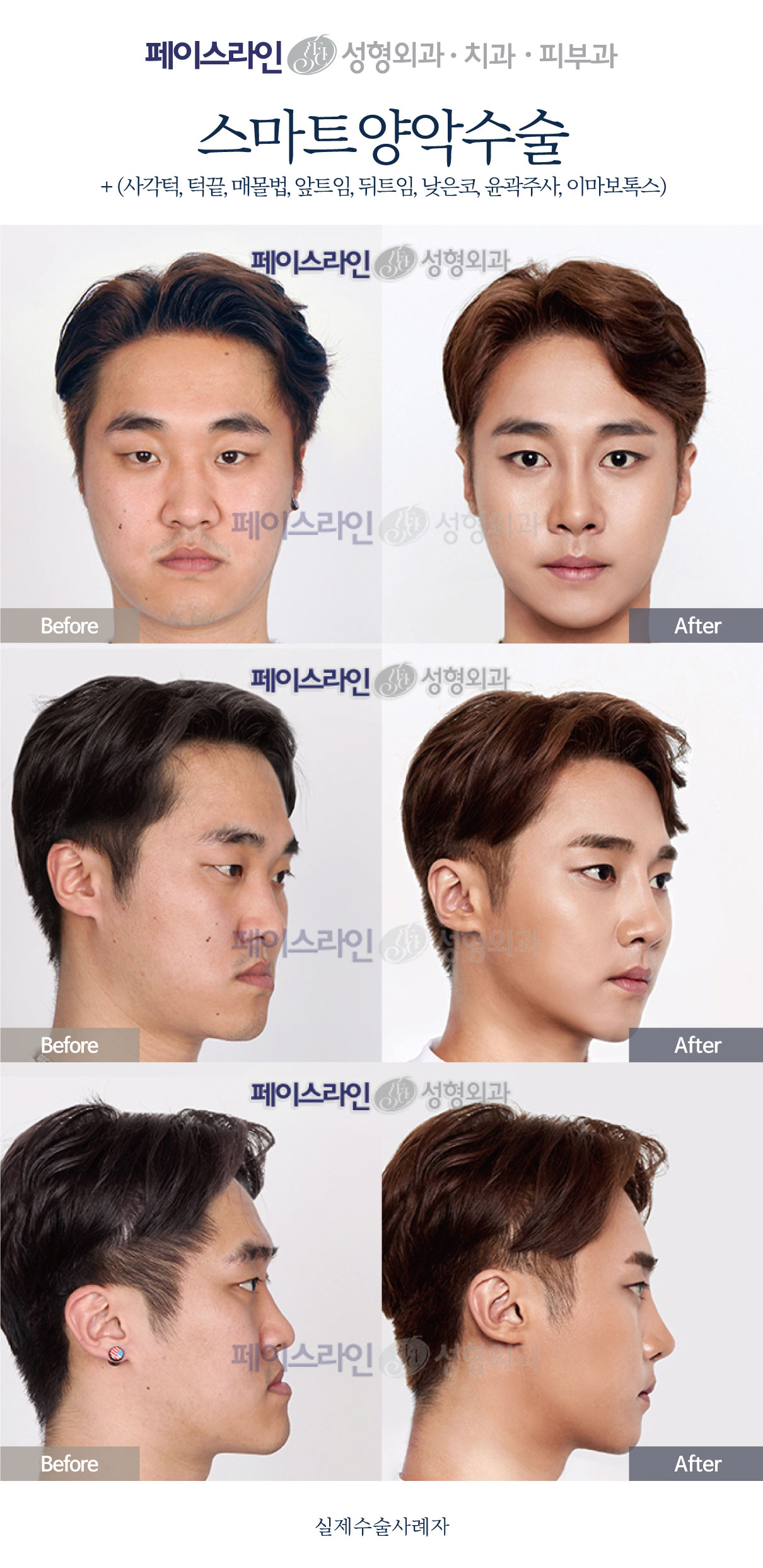 Front, angled and profile views; before on the left and after on the right.