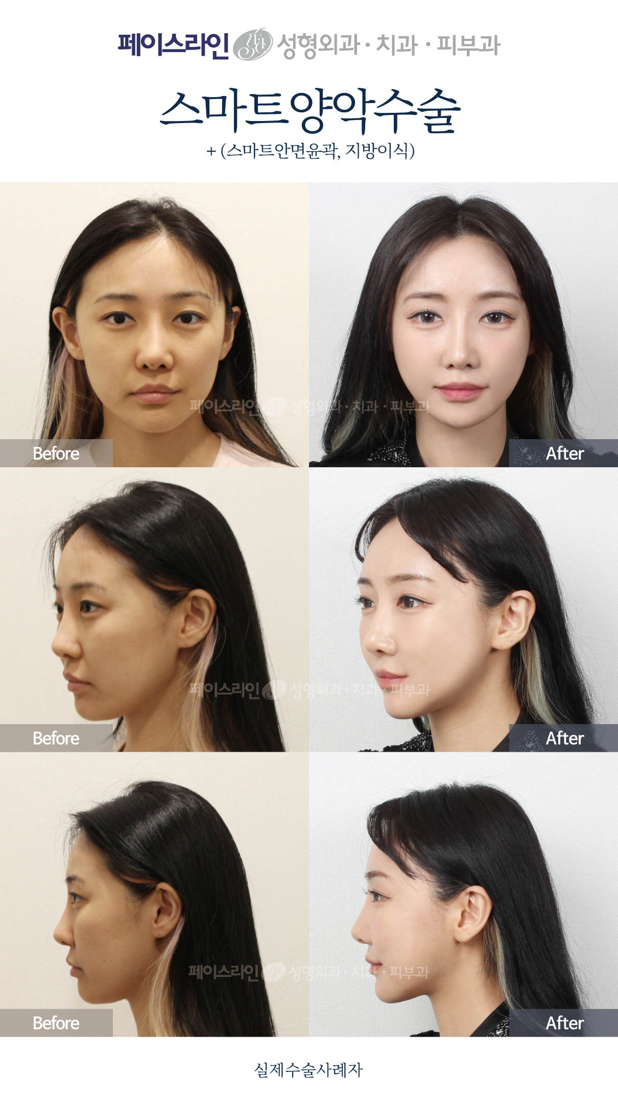 Front, angled and profile views; before on the left and after on the right.