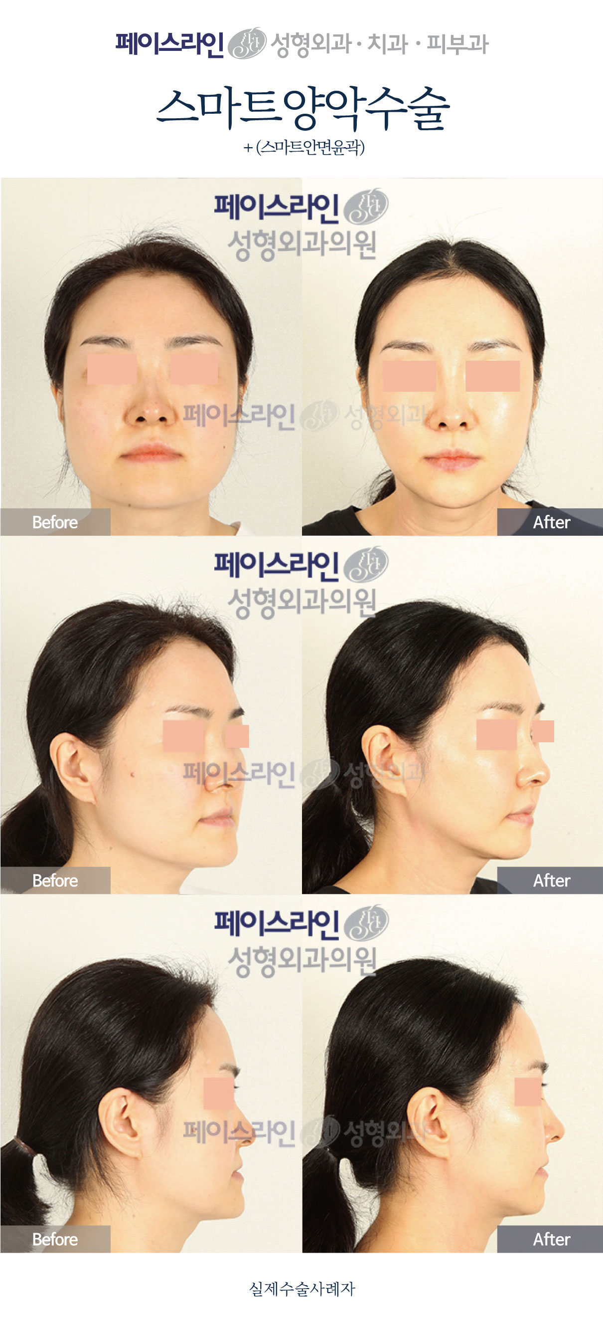 Front, angled and profile views; before on the left and after on the right.