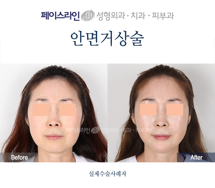 Front view; before on the left and after on the right.