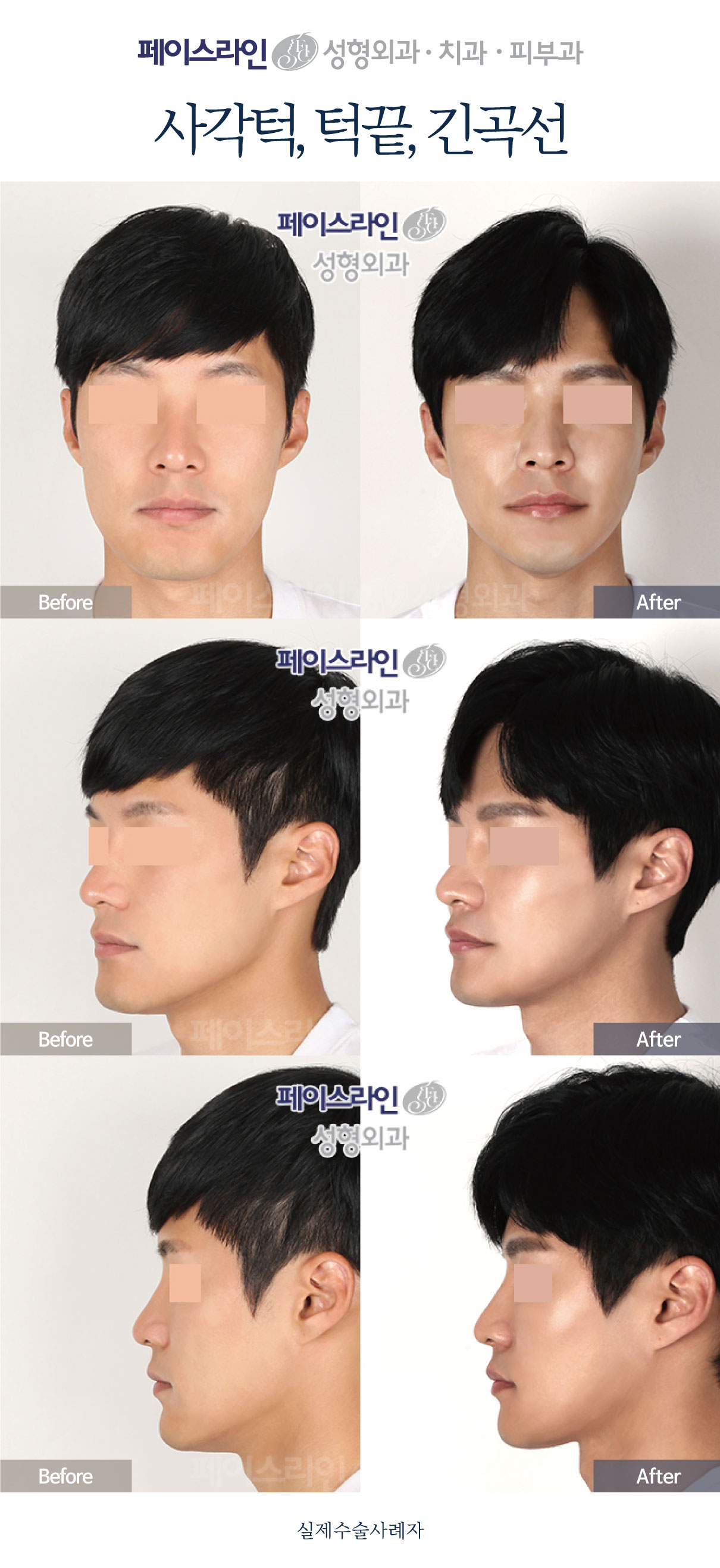 Front, angled and profile views; before on the left and after on the right.