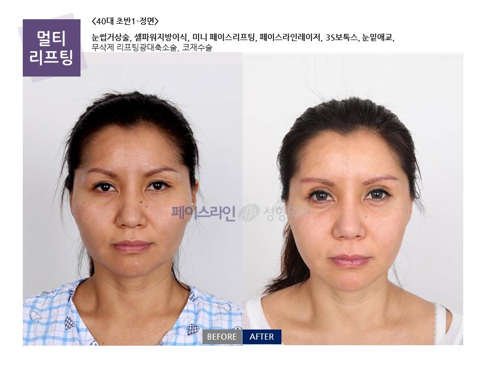 Front view; before on the left and after on the right.