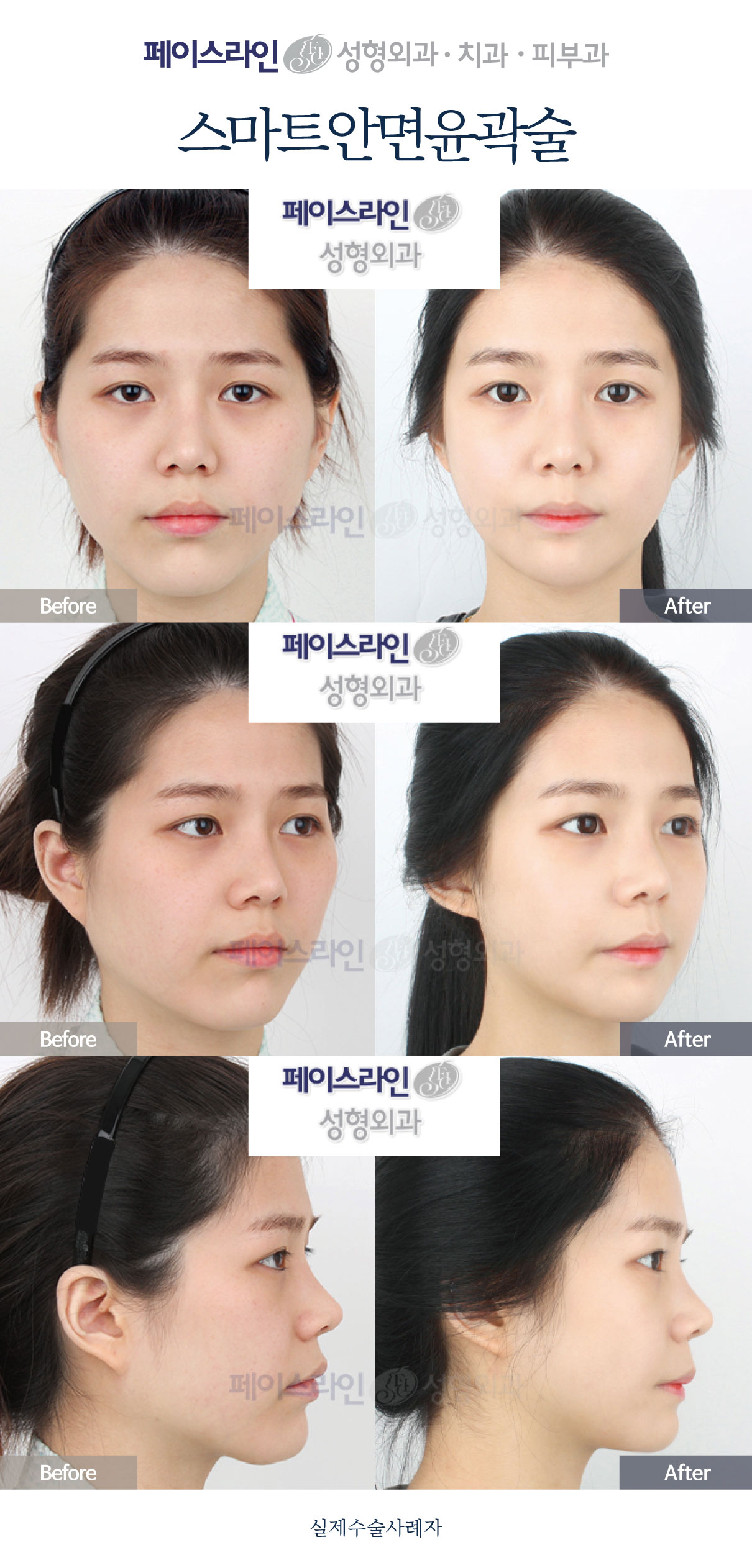 Front, angled and profile views; before on the left and after on the right.