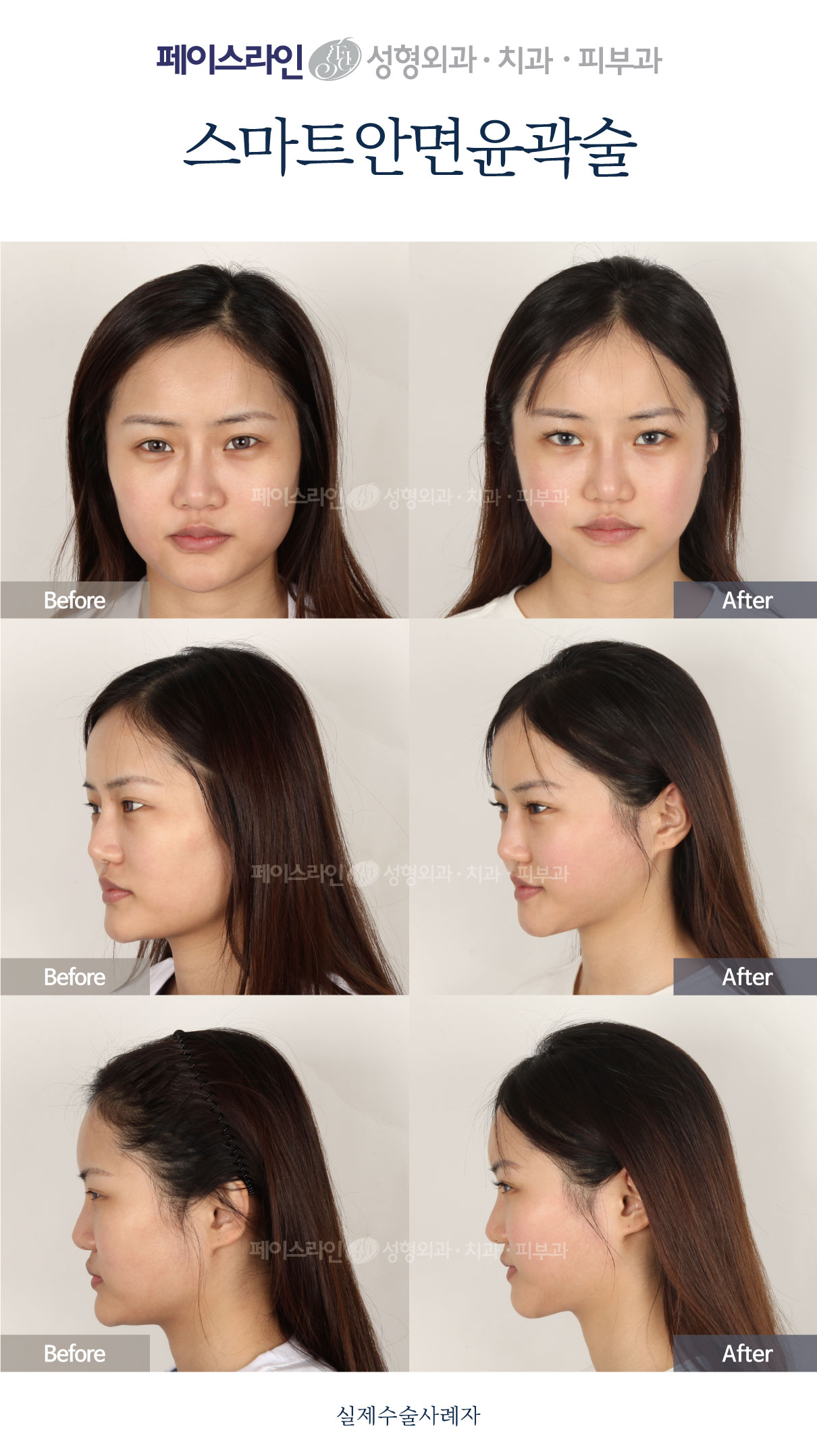 Front, angled and profile views; before on the left and after on the right.