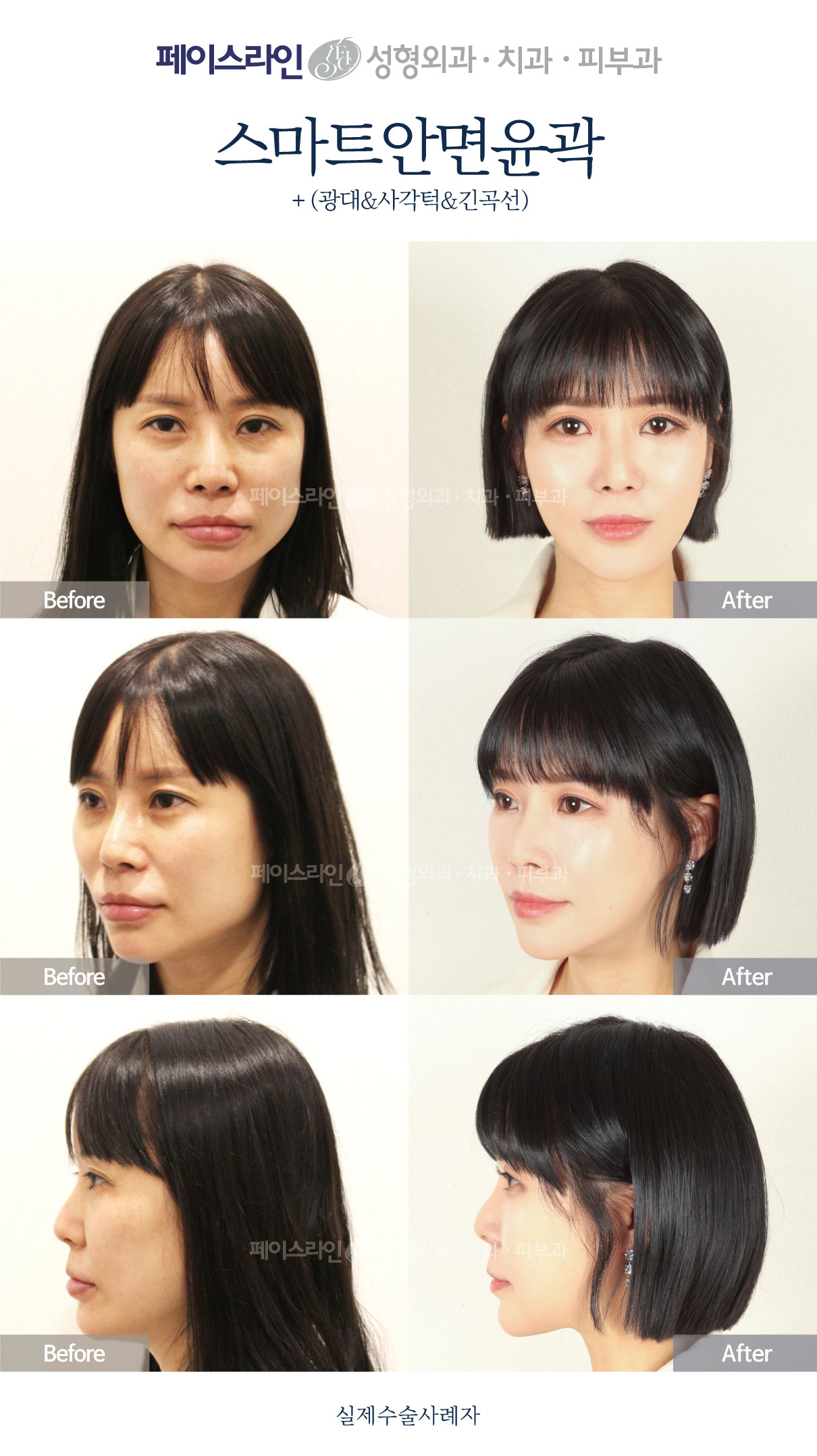 Front, angled and profile views; before on the left and after on the right.