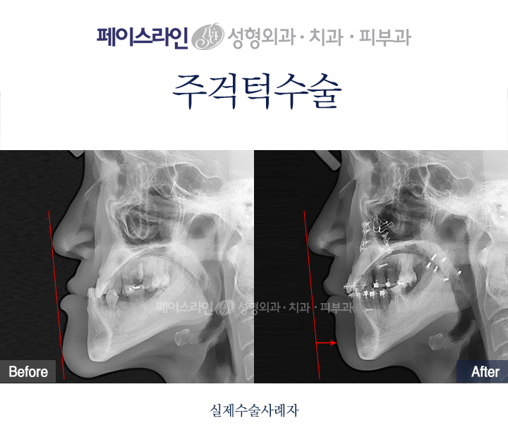 Lateral X-ray views; before on the left and after on the right.