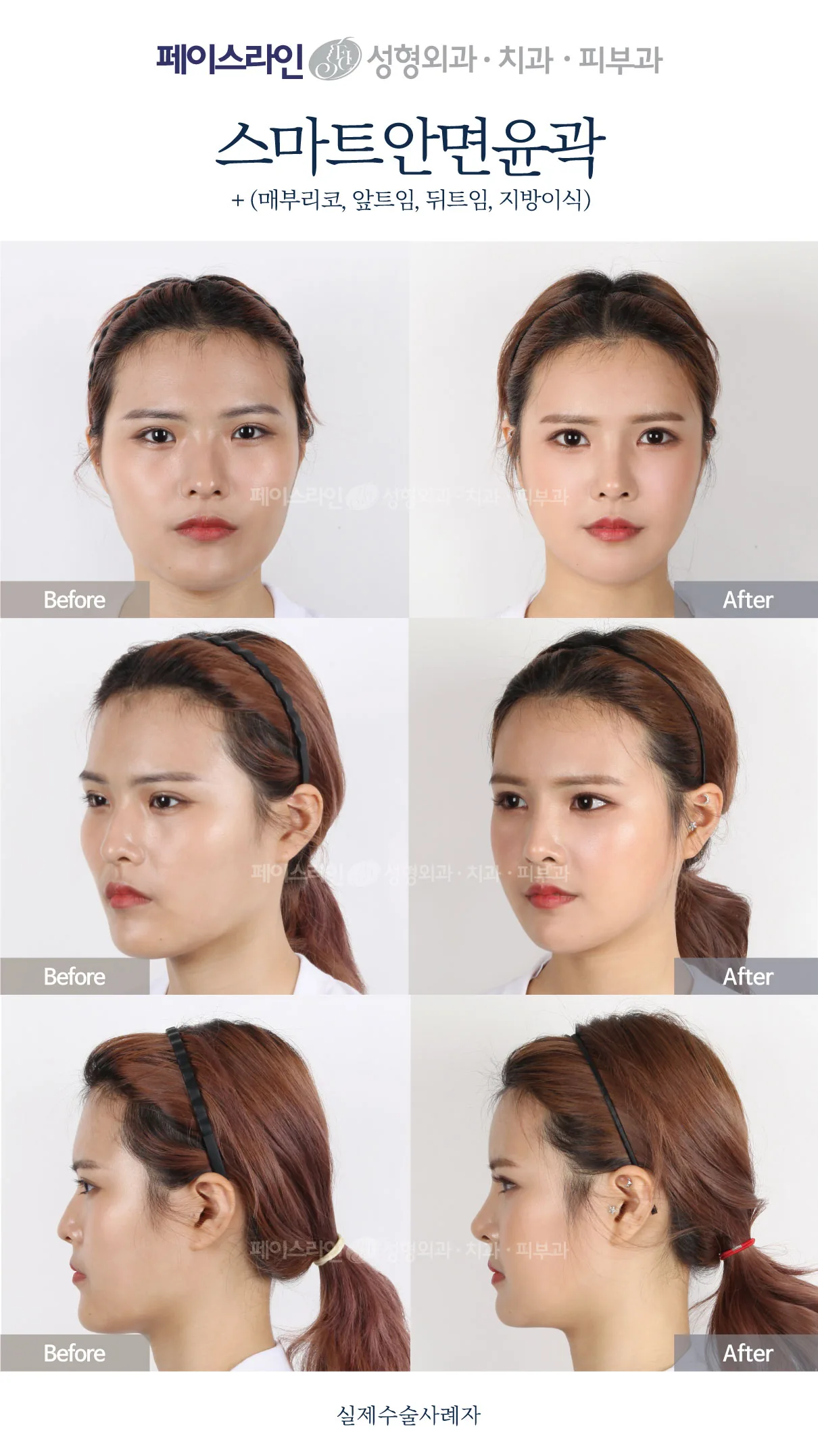 Front, angled and profile views; before on the left and after on the right.