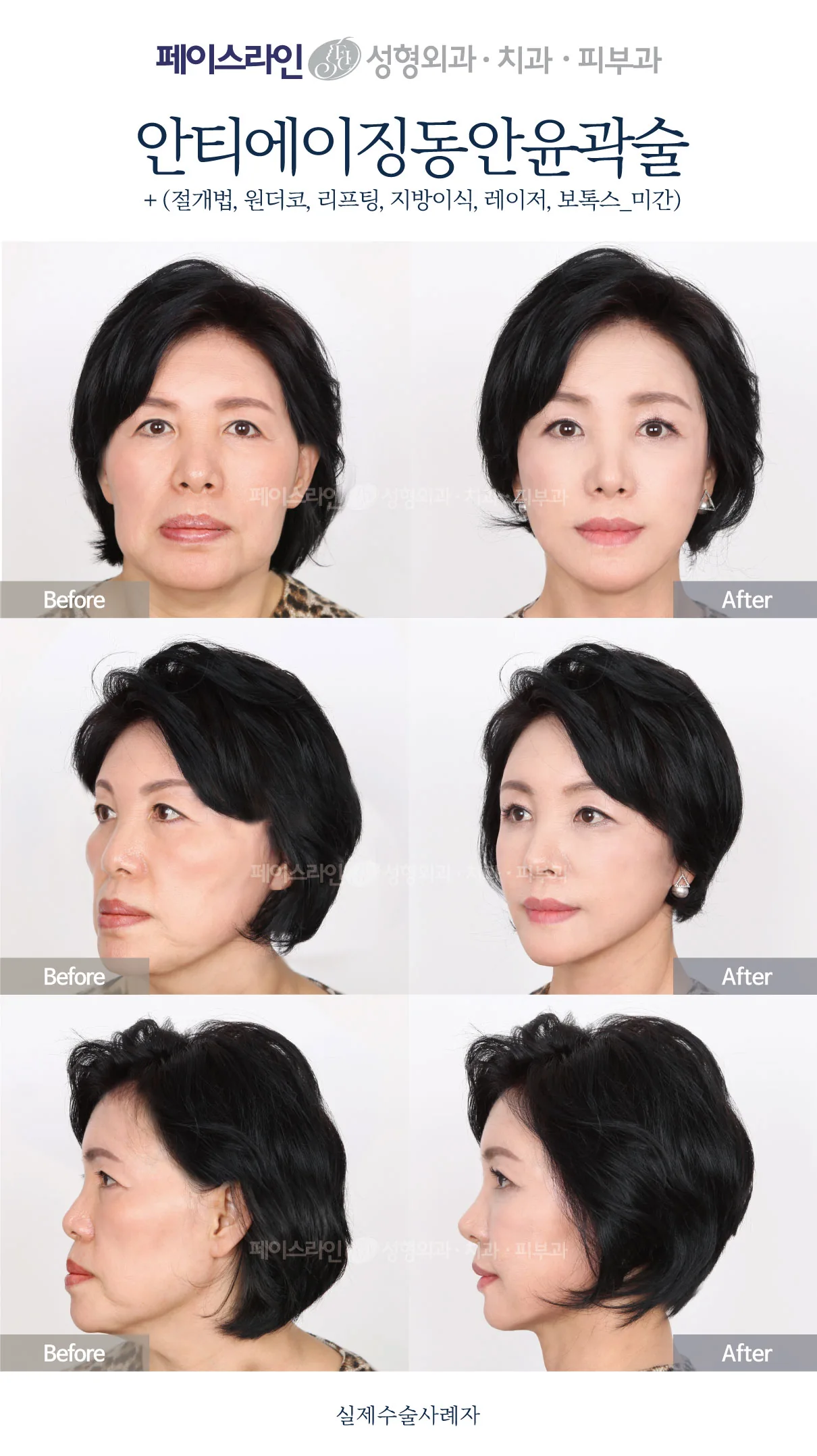 Front, angled and profile views; before on the left and after on the right.