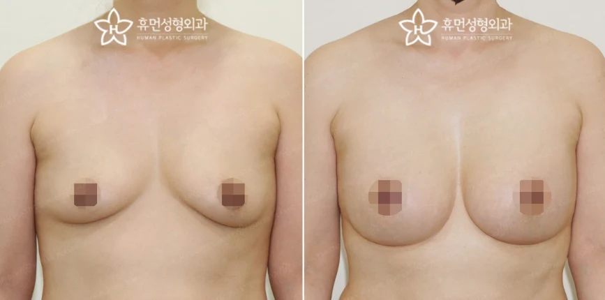 Front view · 5 months after surgery