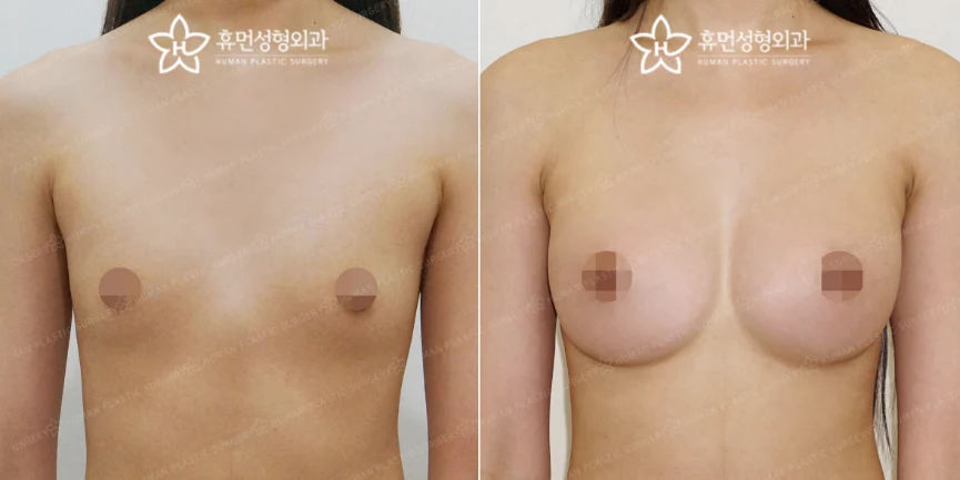 Front view · 6 months after surgery