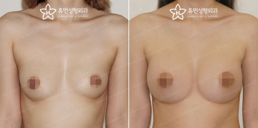 Front view · 7 months after surgery