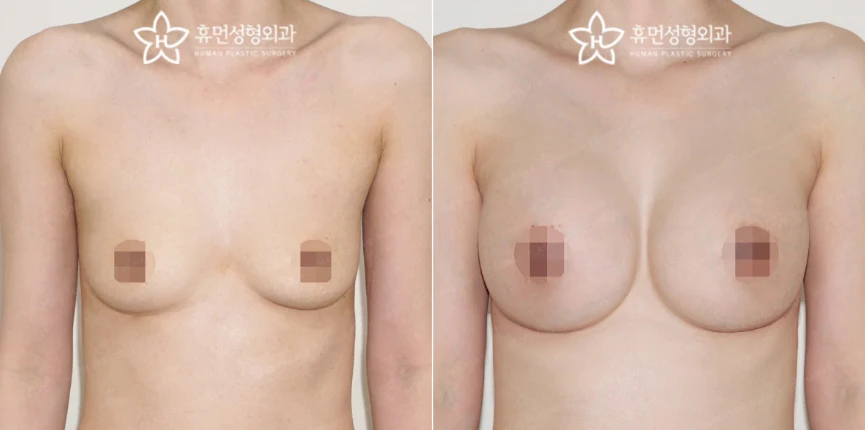 Front view · 5 months after surgery
