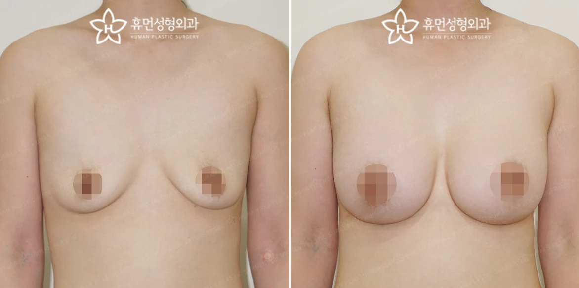 Front view · 6 months after surgery