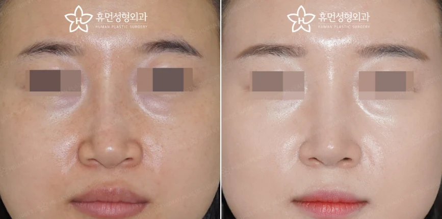 Front view · 3 months after surgery