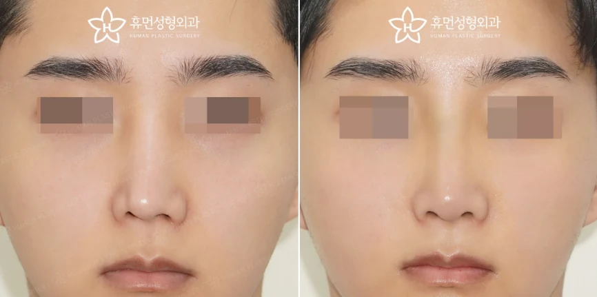 Front view · 3 months after surgery