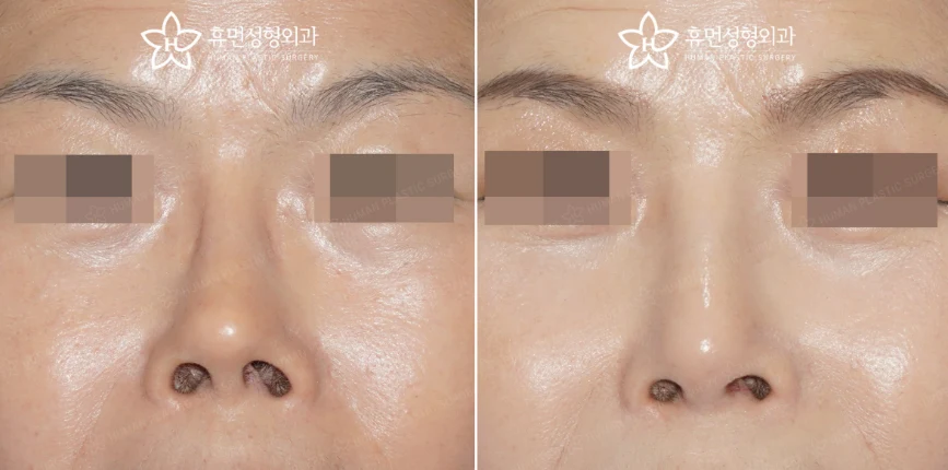 Front view · 3 months after surgery