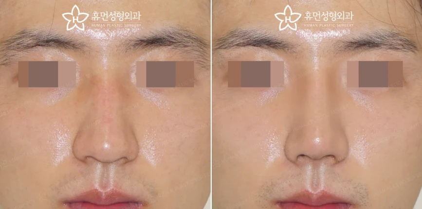 Front view · 5 months after surgery