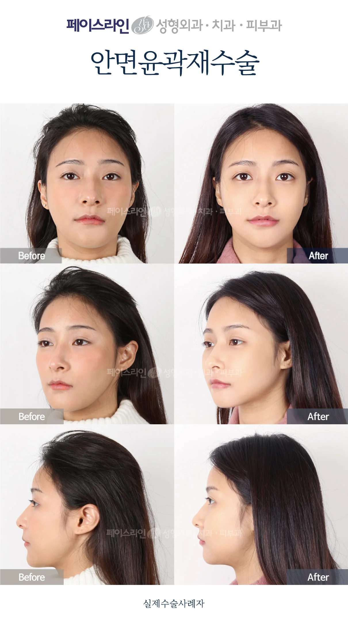 Front, angled and profile views; before on the left and after on the right.