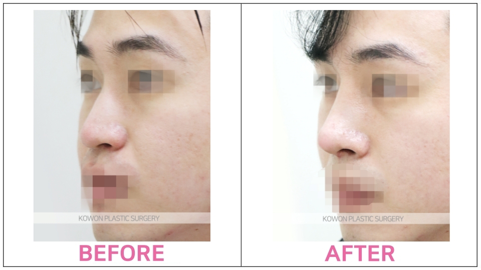 Rhinoplasty by type before and after