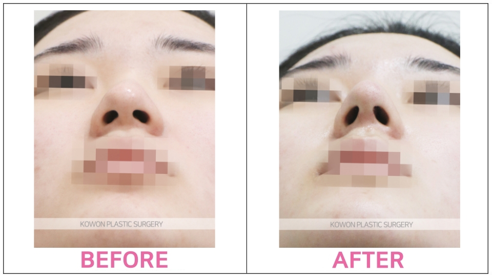 Rhinoplasty by type before and after