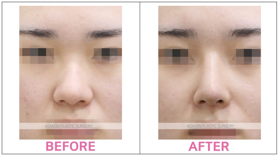 Rhinoplasty by type before and after