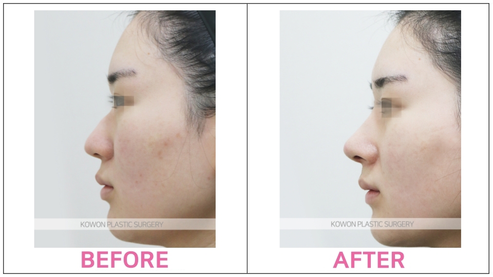 Rhinoplasty by type before and after