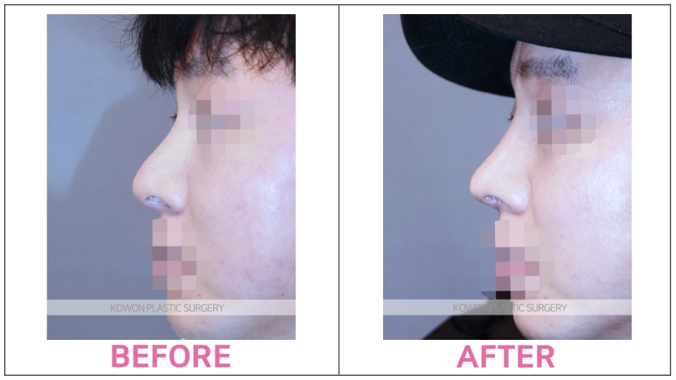 Rhinoplasty by type before and after