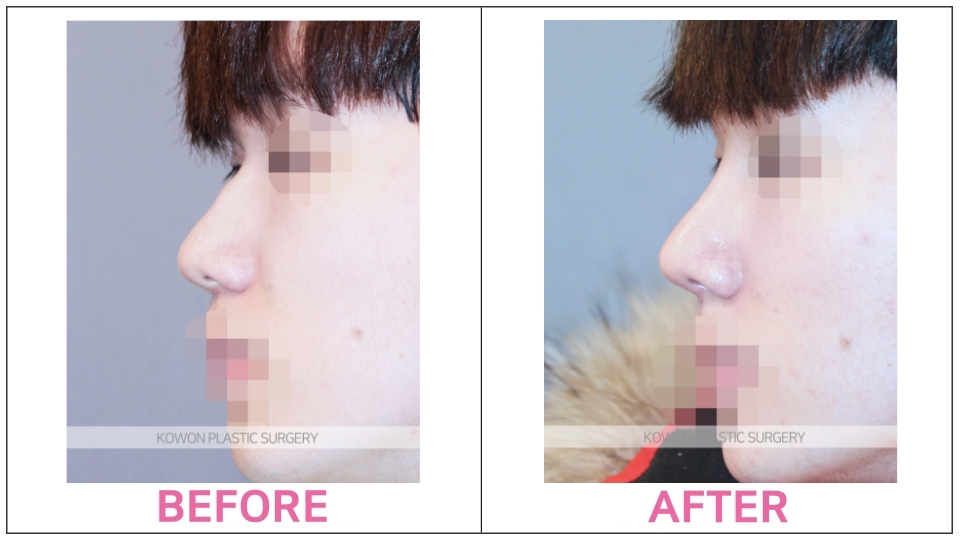 Rhinoplasty by type before and after