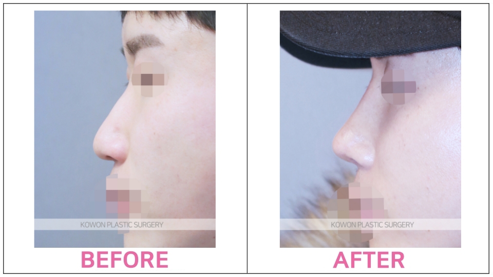 Rhinoplasty by type before and after