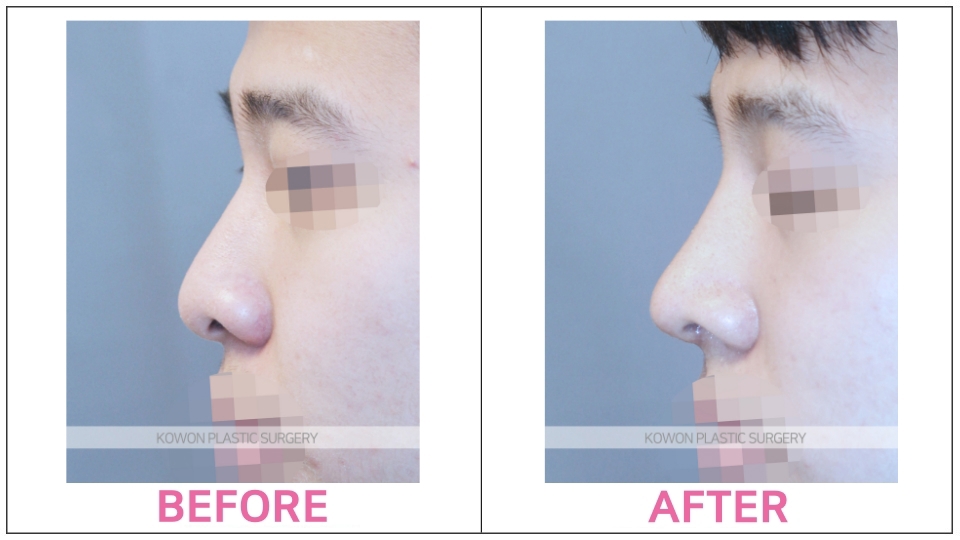 Rhinoplasty by type before and after