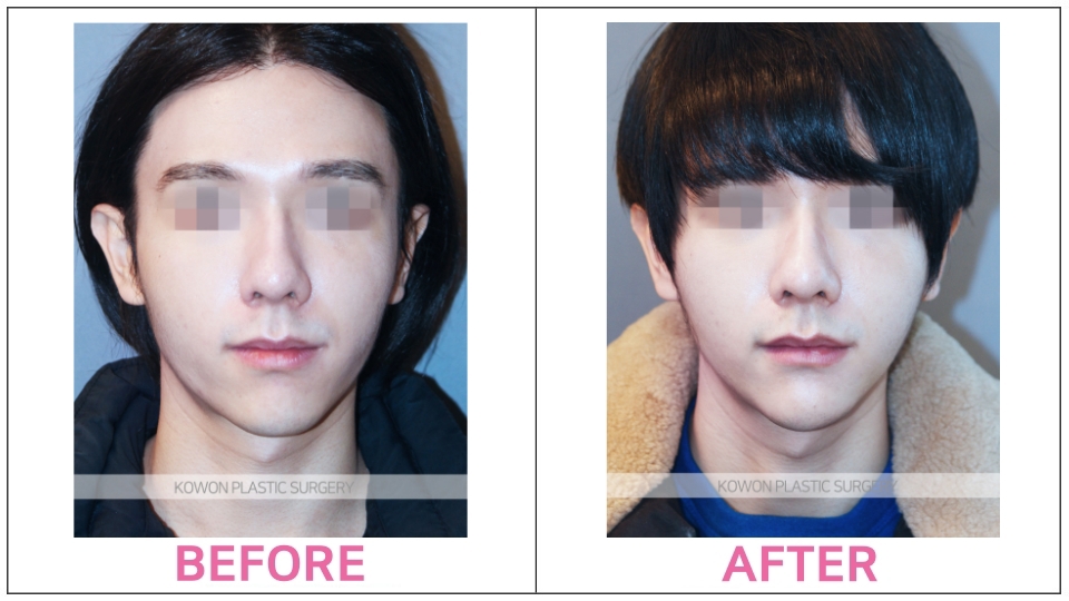 Rhinoplasty by type before and after