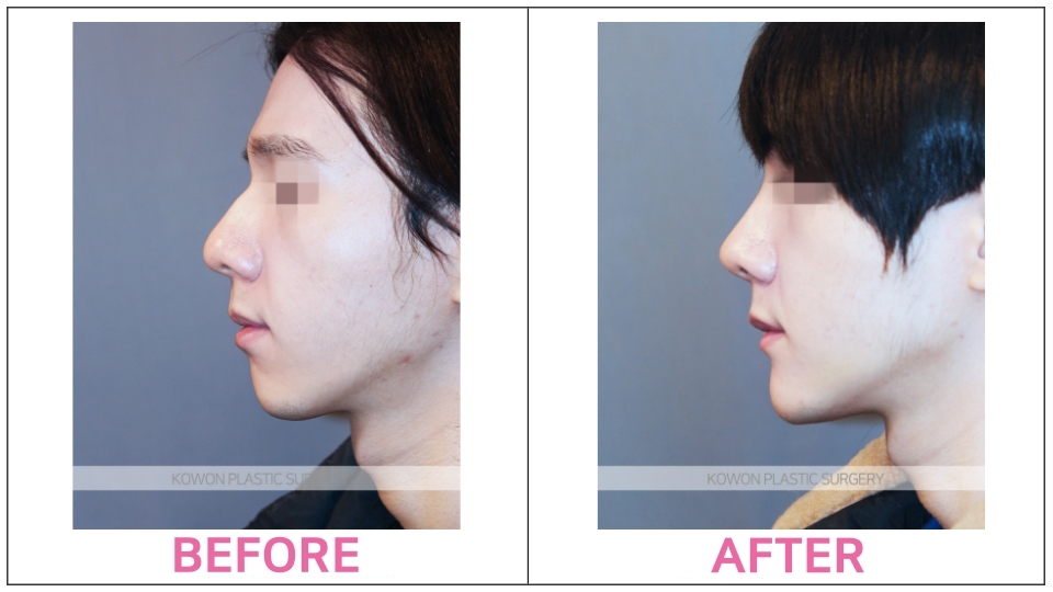 Rhinoplasty by type before and after