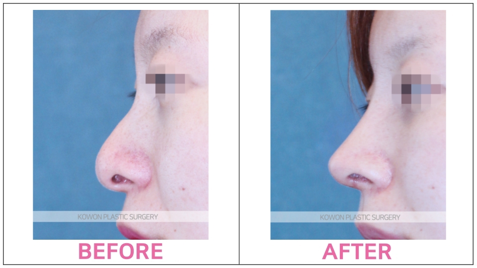 Rhinoplasty by type before and after