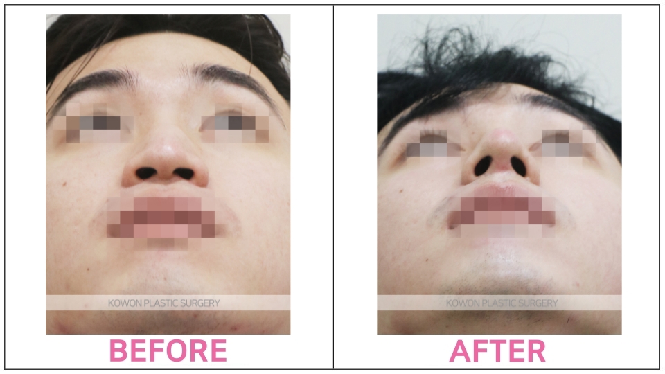 Rhinoplasty by type before and after