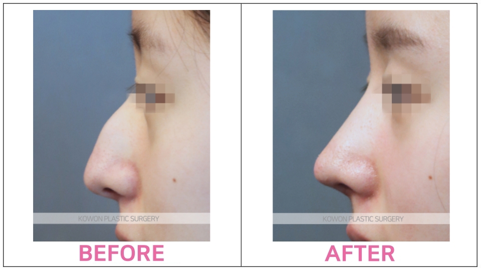 Rhinoplasty by type before and after