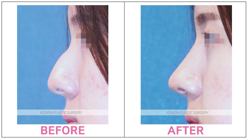 Rhinoplasty by type before and after