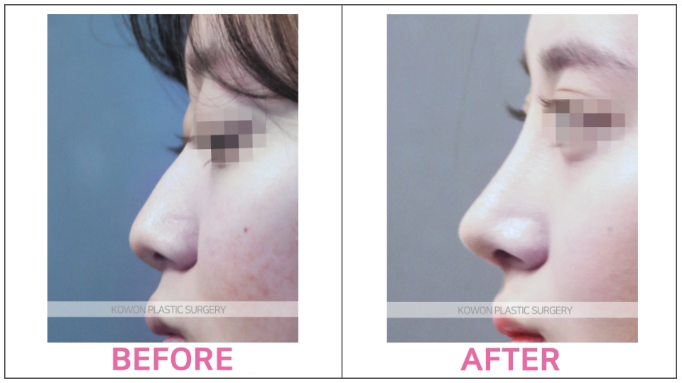 Rhinoplasty by type before and after