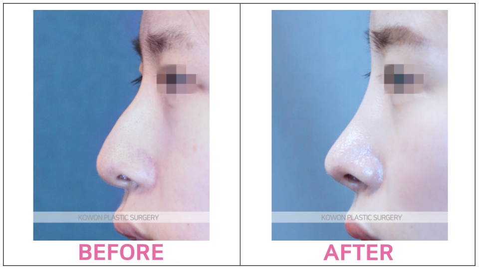 Rhinoplasty by type before and after