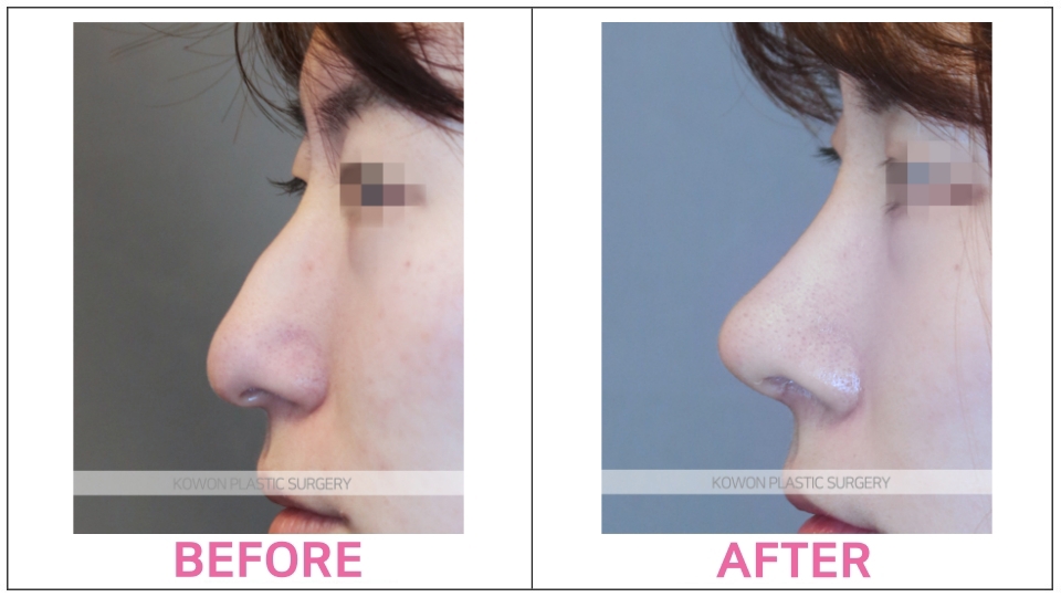 Rhinoplasty by type before and after
