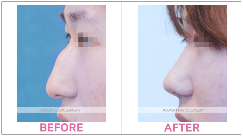 Rhinoplasty by type before and after