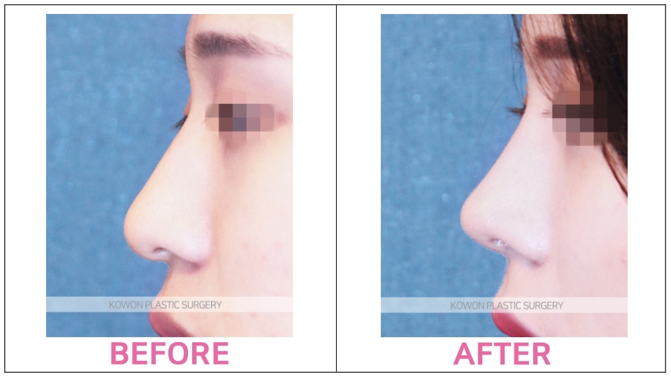 Rhinoplasty by type before and after