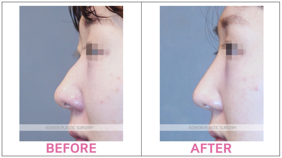 Rhinoplasty by type before and after