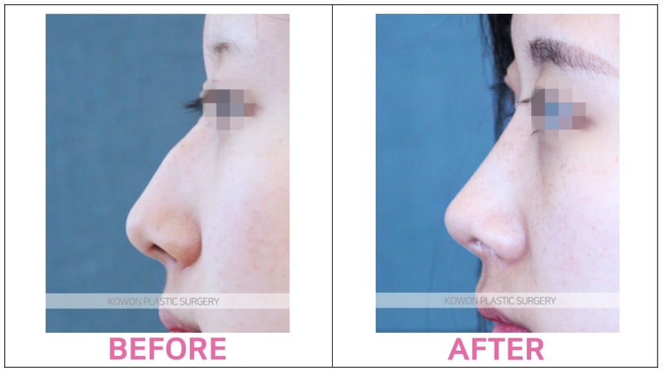 Rhinoplasty by type before and after