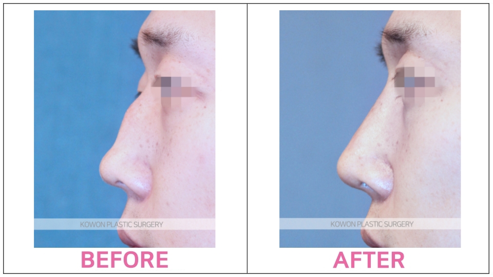 Rhinoplasty by type before and after