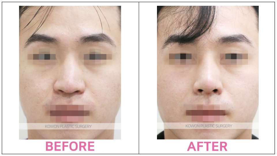 Rhinoplasty by type before and after
